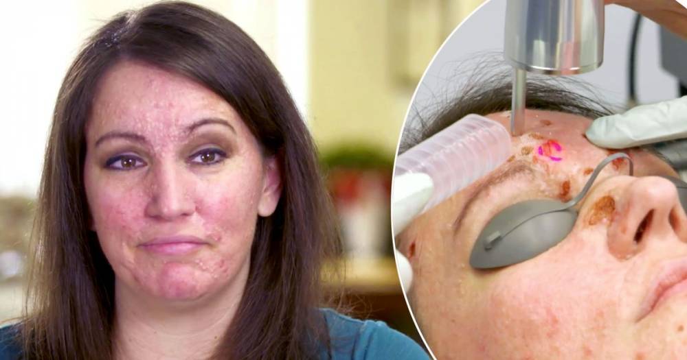 Woman dubbed 'crater face' by bullies has 20 year old face lumps snipped off in new Dr Pimple Popper - www.ok.co.uk
