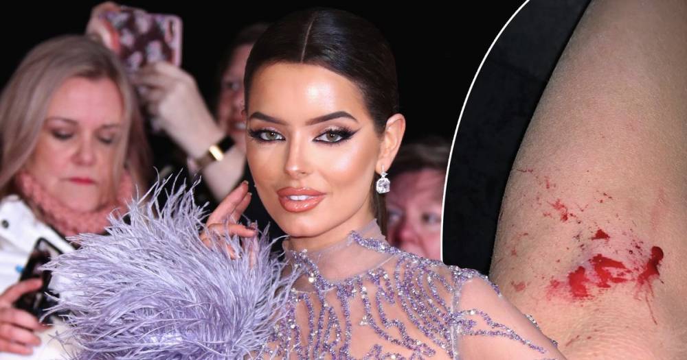 Love Island's Maura Higgins suffers gruesome wound as she leaves National Television Awards bleeding - www.ok.co.uk