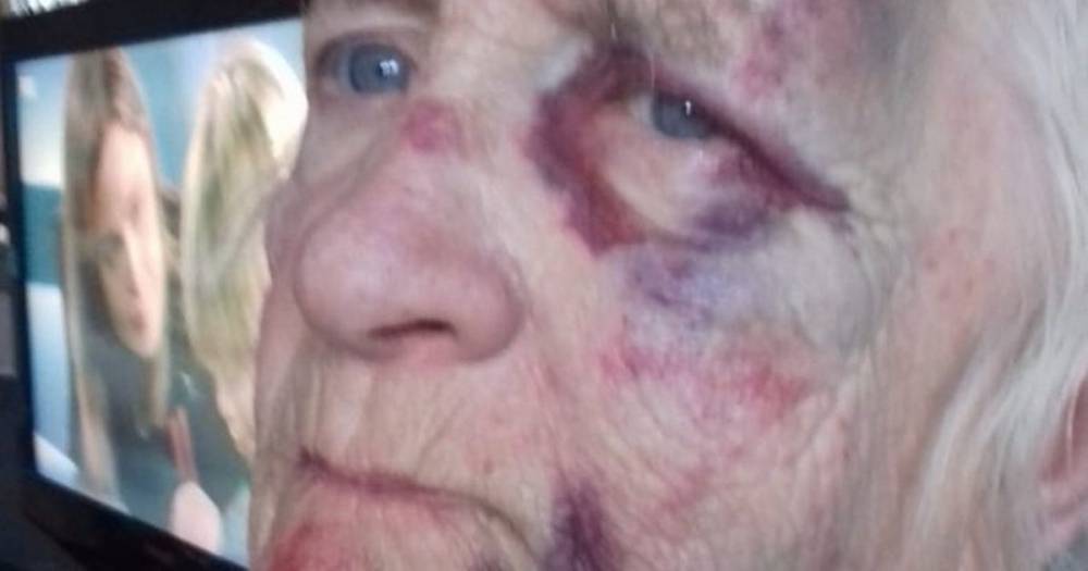 Shock pictures show injuries to Dumbarton pensioner following raid on her home - www.dailyrecord.co.uk