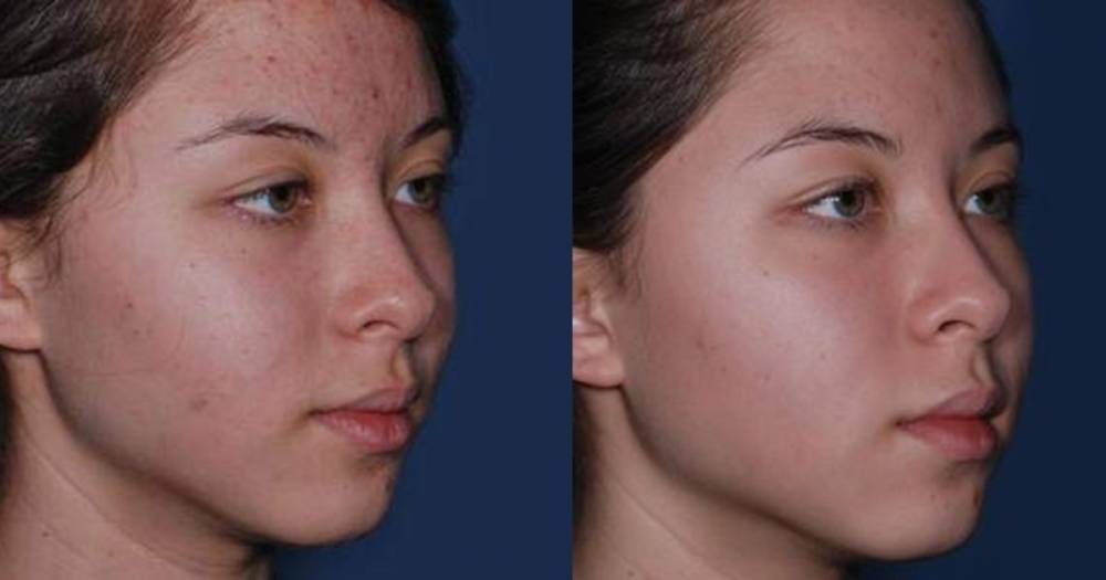 This Obagi Acne Treatment Can Transform Your Skin in a Matter of Weeks - www.usmagazine.com