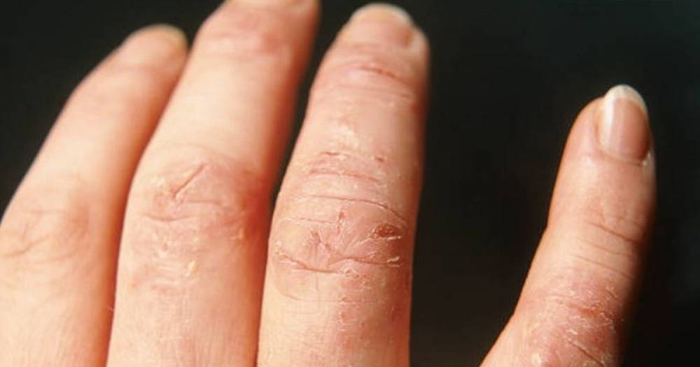 Hand washing advice to ease eczema and dry skin amid coronavirus outbreak - www.manchestereveningnews.co.uk