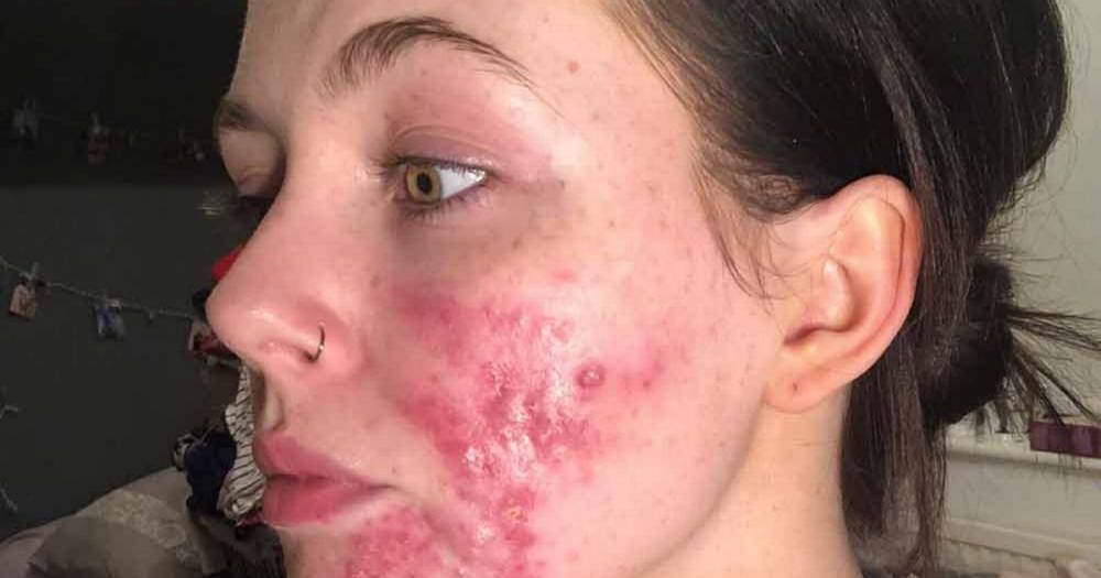 Teacher with severe acne tells how social media trolls stole her pictures to 'give her a Photoshop makeover' - www.manchestereveningnews.co.uk - Manchester