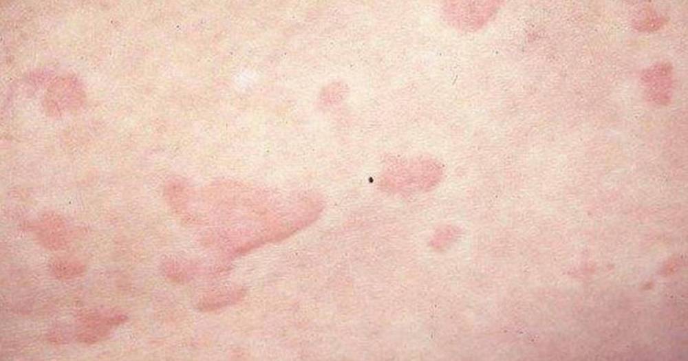 Rash similar to frost bite and 'red hives' could be new coronavirus symptom - www.dailyrecord.co.uk