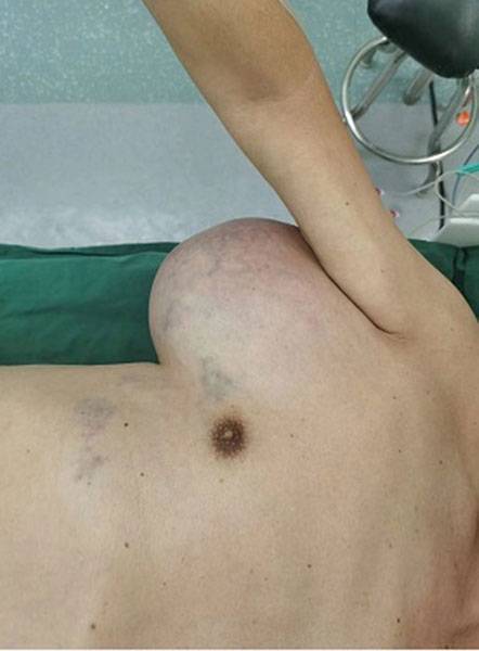 WARNING! Not for sensitive readers! Man’s 2KG Armpit Tumour - www.peoplemagazine.co.za - China