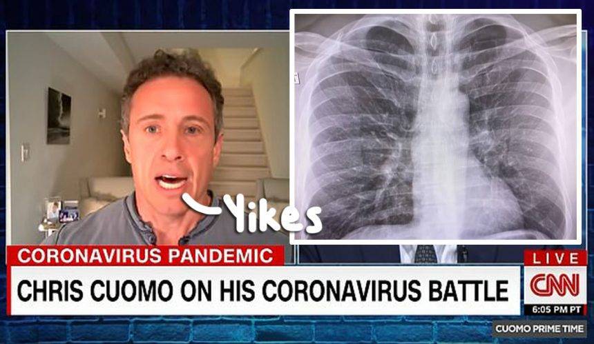 Chris Cuomo Shares X-Ray Showing How The Coronavirus Has Affected His Lungs — Look! - perezhilton.com