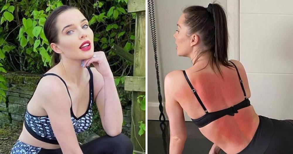 Helen Flanagan reveals she's been in pain since her first pregnancy as she unveils red back from acupressure - www.ok.co.uk - Britain