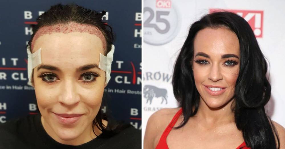 Hollyoaks star Stephanie Davis shows off results of hair transplant six months after having procedure - www.ok.co.uk - Britain