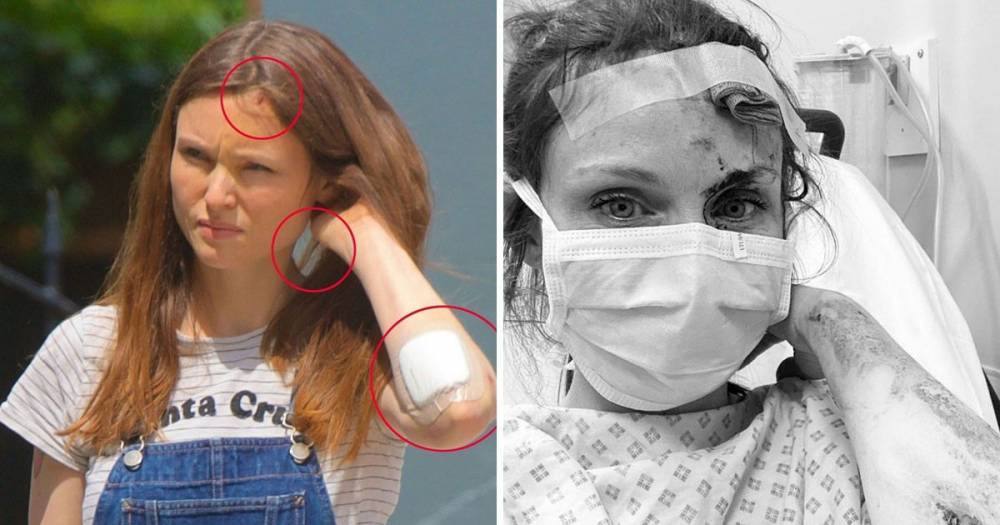 Sophie Ellis-Bextor seen with injuries for the first time since sharing gory cuts from bicycle accident - www.ok.co.uk - London