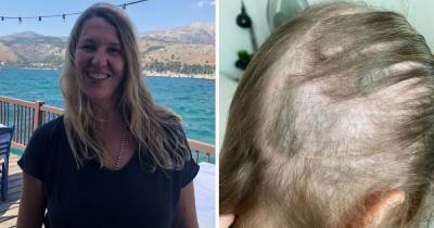 Coronavirus survivor suffers devastating hair loss as experts warn post-Covid shedding is rife - www.ok.co.uk