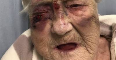 Son blasts Scots care home after elderly mum's face left black and blue from dangerous falls as staff blame 'wrong slippers' - www.dailyrecord.co.uk - Scotland - county Livingston
