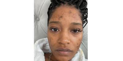 Keke Palmer Gets Candid About Her Battle With Polycystic Ovary Syndrome (PCOS) & Acne - www.justjared.com