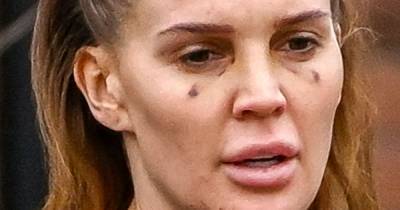 Danielle Lloyd is spotted with bruises under her eyes after trip to cosmetic clinic in Turkey - www.ok.co.uk - county Sutton - Turkey