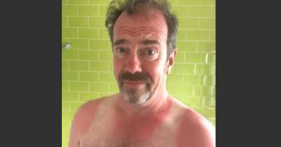 Still Game's Gavin Mitchell suffers sunburn blunder leaving him with more than a red face - www.dailyrecord.co.uk - Scotland
