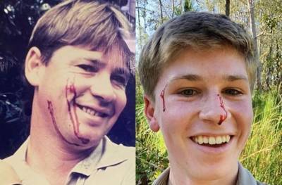 Robert Irwin Bit On The Face By A Snake — Just Like His ‘Crocodile Hunter’ Dad Years Earlier - etcanada.com