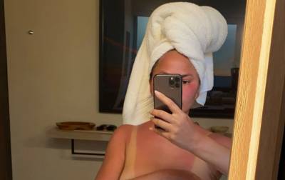 Chrissy Teigen Goes Topless to Show Off Her Sunburn - www.justjared.com