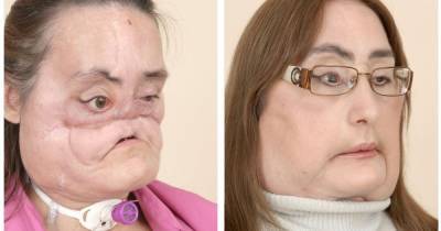 First woman to undergo face transplant in US after being shot by husband dies aged 57 - www.dailyrecord.co.uk - USA - Ohio