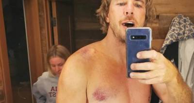 Dax Shepard shows off bruises from recent bike accident while recalling the details of the scary incident - www.pinkvilla.com - California
