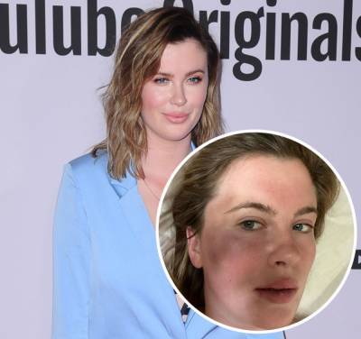Ireland Baldwin Shares MASSIVE Bruise After Being ‘Attacked’ In A Parking Lot - perezhilton.com - Ireland