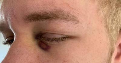 Teenager suffers fractured eye socket in 'unprovoked' attack on night out - www.manchestereveningnews.co.uk