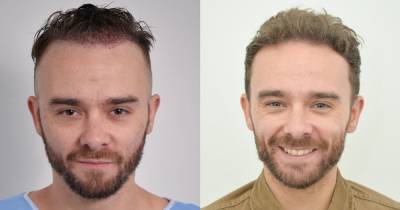 Jack P Shepherd shows off results of second hair transplant after hair loss left him 'feeling depressed' - www.ok.co.uk