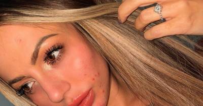 Holly Hagan bravely shows off her spots in make-up free snap as she opens up on beauty dysmorphia - www.ok.co.uk