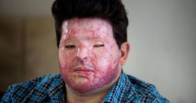 Dad left scarred for life in horror acid attack hits out as attacker 'freed' after just five years - www.dailyrecord.co.uk