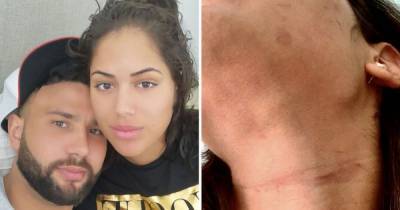 Malin Andersson shares photos of bruises as ex boyfriend Tom Kemp has been jailed for ten months - www.ok.co.uk