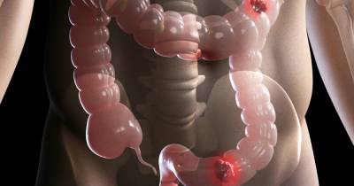 Bowel cancer warning signs and symptoms you should never ignore - www.dailyrecord.co.uk - Britain