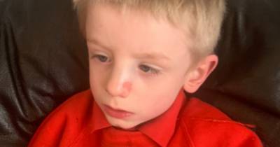 Mum says son with disabilities 'neglected' after he broke nose at Scots school - www.dailyrecord.co.uk - Scotland