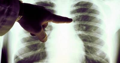 NHS Lanarkshire urges locals not to ignore lung cancer symptoms - www.dailyrecord.co.uk - Scotland