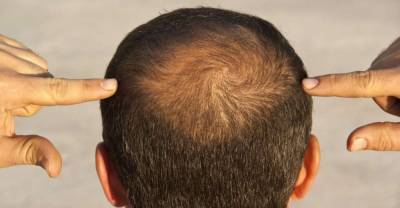 I don’t want a cure for baldness – I’ve learnt to love the smooth look - www.msn.com