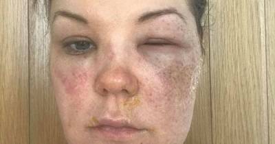 Loose Women egg hack explodes in mum's face leaving her with 'excruciating' burns - www.dailyrecord.co.uk - Ireland