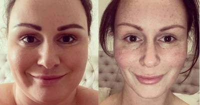 Chanelle Hayes shares snap of horrible cuts and bruises obtained from weight loss surgery which helped her shed seven stone - www.ok.co.uk