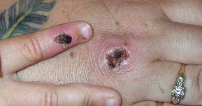 Two cases of rare monkeypox virus identified in north Wales - www.manchestereveningnews.co.uk - Britain