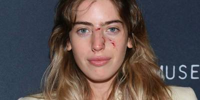 Ewan McGregor's Daughter Clara Walks the Red Carpet With Dog Bite Wounds on Her Face - www.justjared.com - Las Vegas