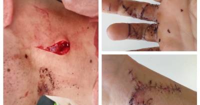 The shocking injuries suffered by two young pals attacked by a knifeman as they hung out in their woodland den - www.manchestereveningnews.co.uk
