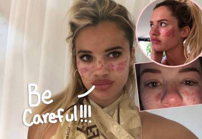 TikTok Freckle DIY Goes Horribly Wrong! STOP AND READ THIS!!! - perezhilton.com
