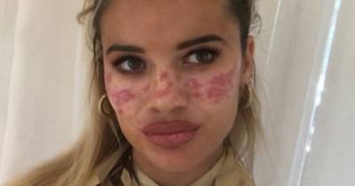 Woman left with facial burns and temporary blindness after trying viral TikTok beauty trend - www.manchestereveningnews.co.uk