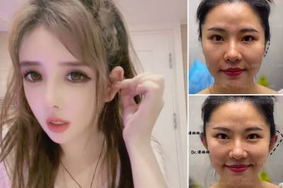 ‘Elf ears’ are the creepy new plastic surgery trend in China - nypost.com - China
