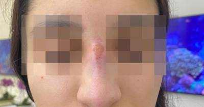 Woman left with rotting nose after botched surgery urges others to be careful - www.dailyrecord.co.uk - Manchester