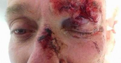Yobs leave Good Samaritan covered in blood with fractured eye socket after savage attack - www.dailyrecord.co.uk