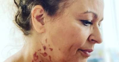 Loose Women's Nadia Sawalha reveals horror burns injury after 'week from hell' - www.ok.co.uk