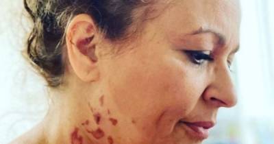 Nadia Sawalha reveals 'agonising' neck burns after being scalded in freak kitchen accident - www.manchestereveningnews.co.uk