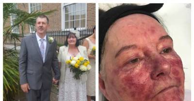 Widow who lived like a hermit for eight years as devastating grief triggered skin condition which looked like massive burns has found love again - www.manchestereveningnews.co.uk