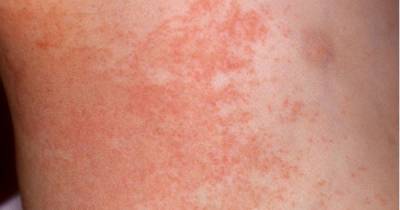 How to treat and prevent heat rash in adults and children - www.manchestereveningnews.co.uk - Manchester