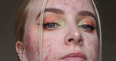 Young woman switched contraceptive pill and developed acne so severe she did not want to leave the house - www.manchestereveningnews.co.uk