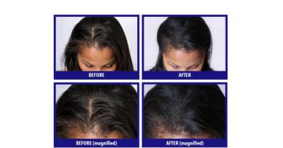 Find Out What Sets This Hair Loss Vitamin Apart From the Rest - www.usmagazine.com