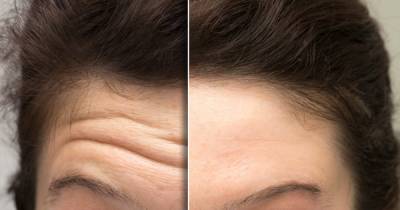 Shoppers Say This New Treatment Is Making Their Forehead Lines ‘Disappear’ - www.usmagazine.com