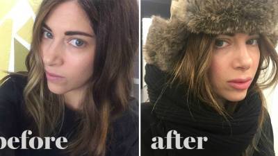 9 Things I Wish I’d Known Before Getting Lip Injections - www.glamour.com
