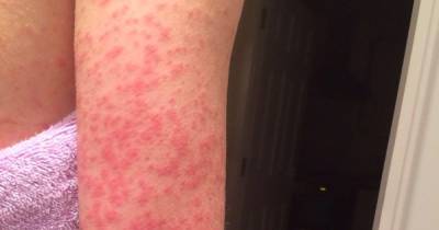Experts indicate eight types of skin rash that could be a symptom of Covid - www.dailyrecord.co.uk - Scotland - London